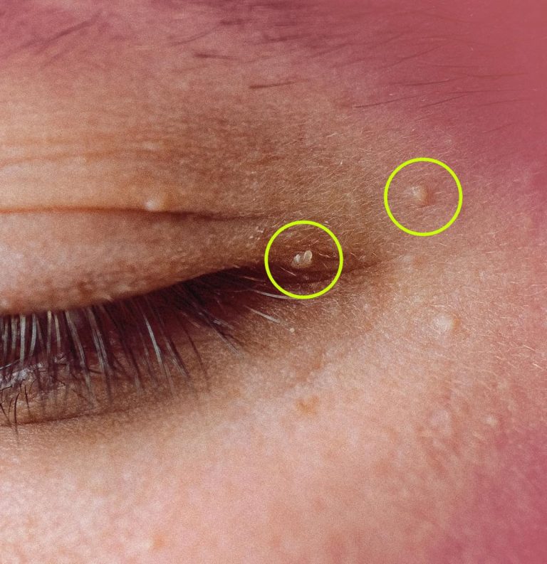 Jak pozbyć się prosaków: tych irytujących torbieli tłuszczowych