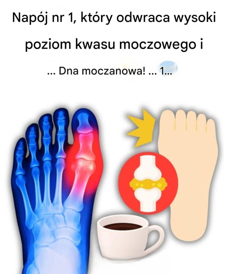 Napój nr 1 na odwrócenie objawów wysokiego poziomu kwasu moczowego i dny moczanowej!