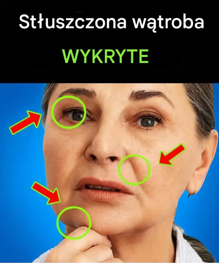 szyscy ze stłuszczeniem wątroby mają to samo! Ukryty objaw, o którym powinieneś wiedzieć.