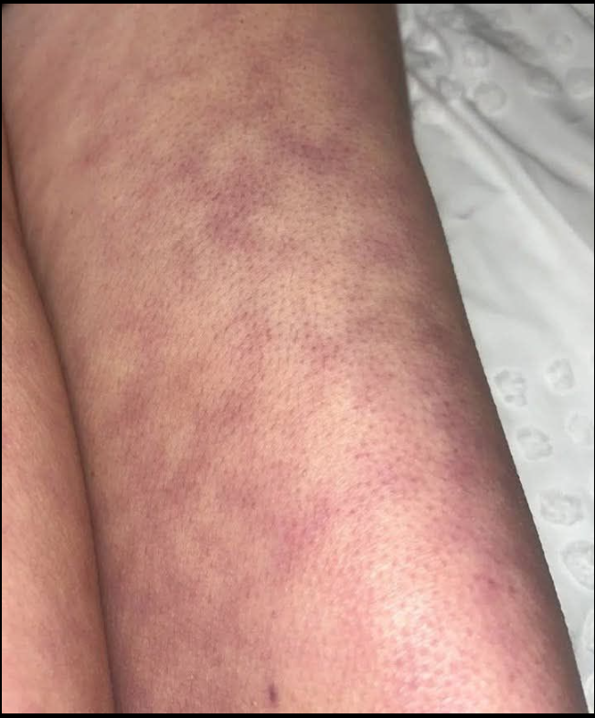 Marszczenie się skóry (livedo): przyczyny i różne metody leczenia