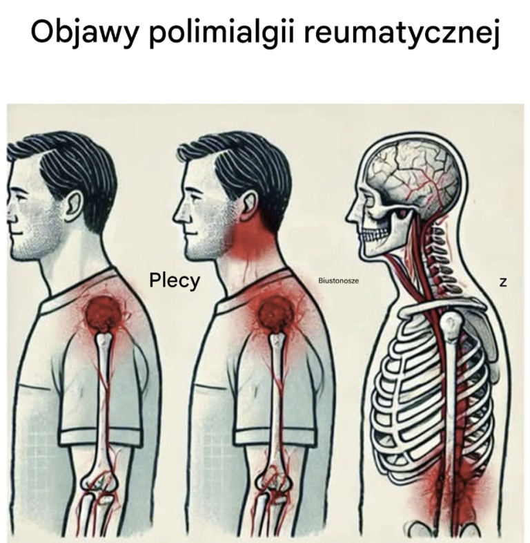 Objawy, na które należy zwrócić uwagę i które mogą wskazywać na polimialgię reumatyczną