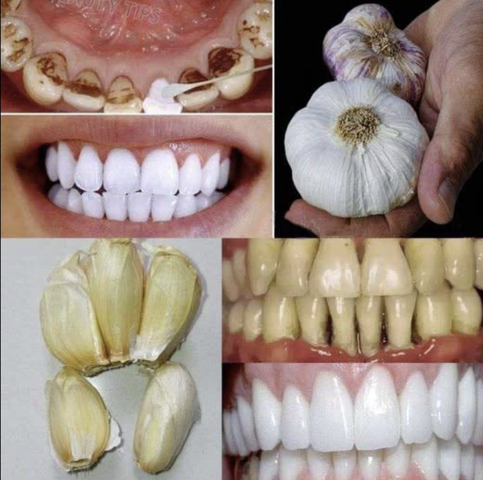Jak wybielić zęby i usunąć kamień nazębny za pomocą czosnku?