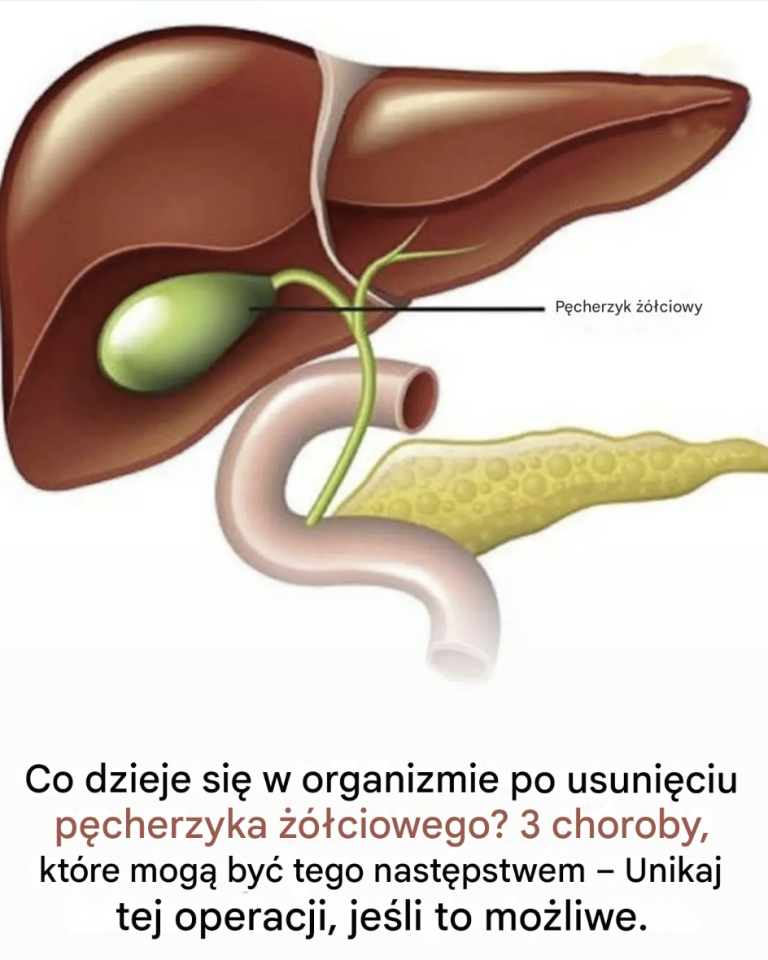 Mało znane konsekwencje usunięcia pęcherzyka żółciowego: wpływ na zdrowie, na który należy zwrócić uwagę
